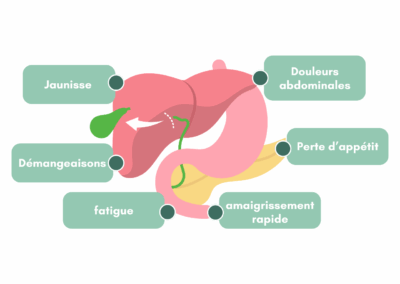 Cancers des voies biliaires : quels sont les symptômes à surveiller ?